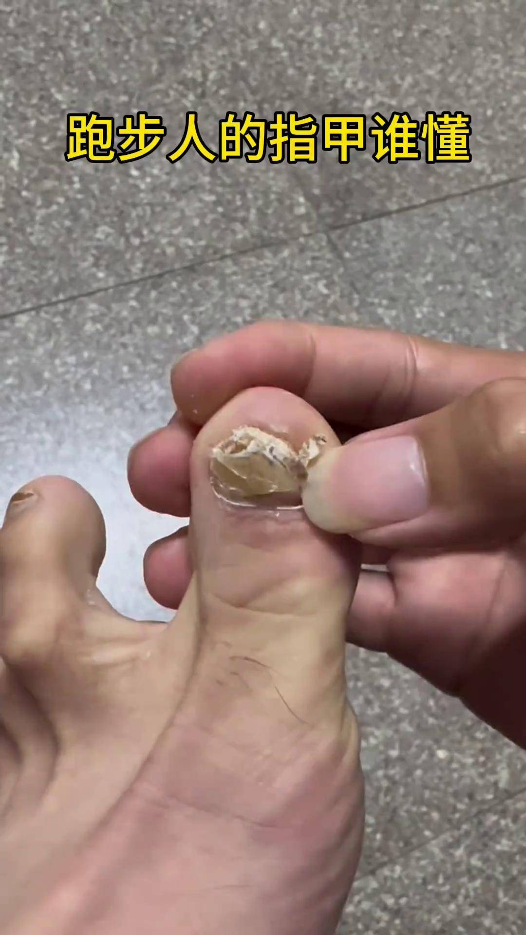 脚趾甲盖自动脱落会长出新的吗图片