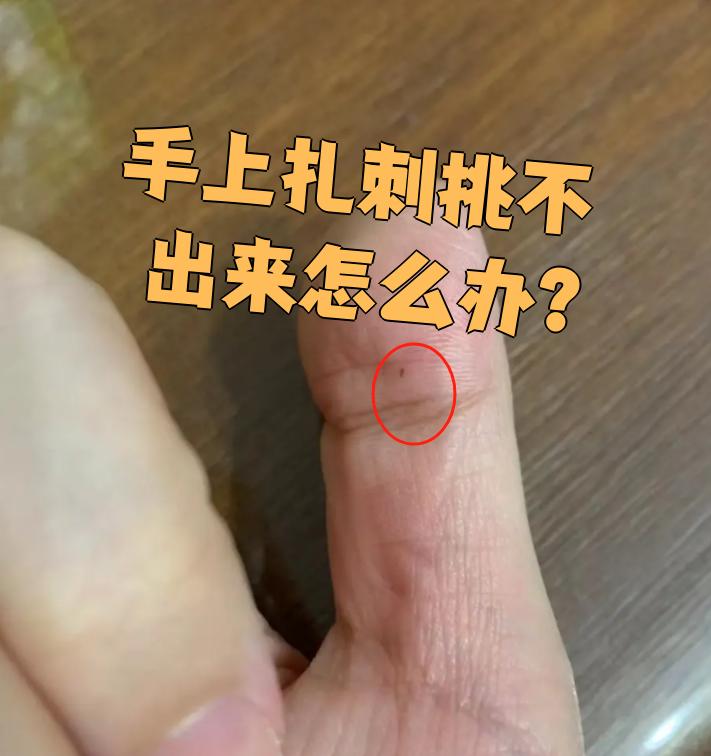 手被刺扎了怎么取出来不疼